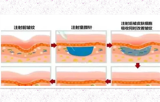 童颜针是什么成分 童颜针是生长因子吗