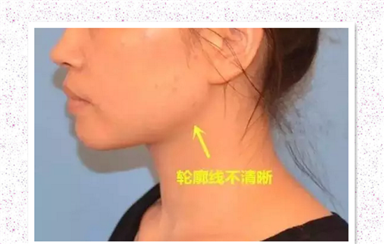埋线提升面部适合年纪 埋线提升适合多大年龄