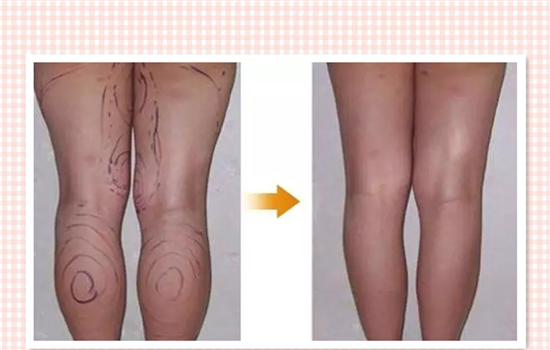 大腿环吸是什么意思 大腿环抽什么意思