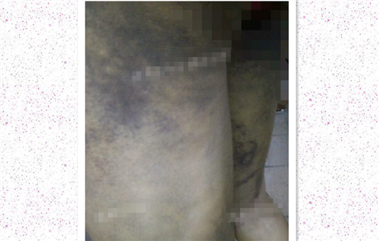 大腿吸脂有什么不好 大腿吸脂有什么危害