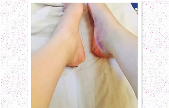 大腿吸脂有什么不好 大腿吸脂有什么危害