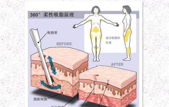 腹部吸脂术后护理要点 腹部吸脂术后该如何护理
