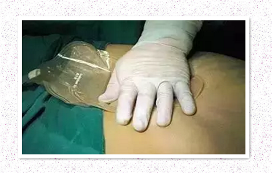 腹部抽脂的危害有哪些 腰腹部抽脂有哪些危害