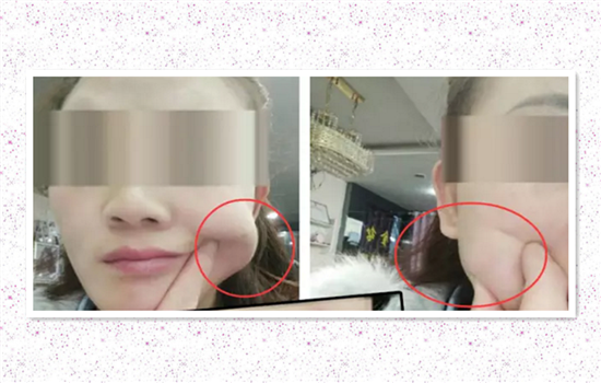 下巴打完玻尿酸有硬块怎么回事 下巴打了玻尿酸有硬块