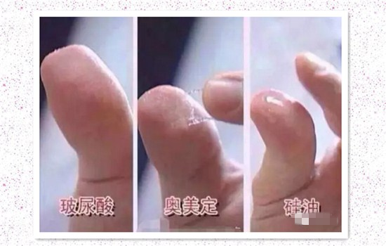 乔雅登真假辨别图片 乔雅登玻尿酸真假分辨