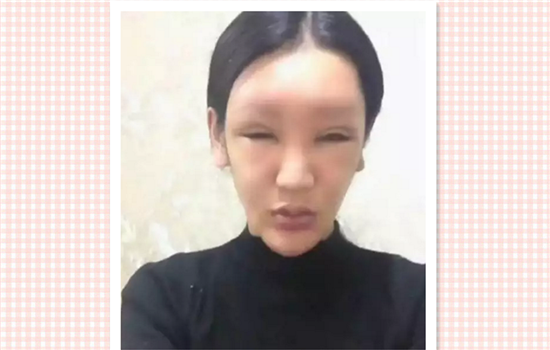打玻尿酸脸肿了怎么办 打完玻尿酸脸肿怎么办