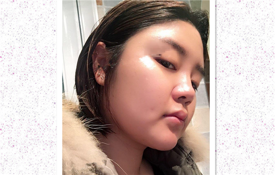 面部吸脂真实案例 脸部吸脂真实记录日记