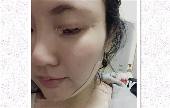 面部吸脂真实案例 脸部吸脂真实记录日记