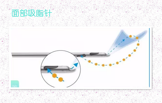 面部吸脂是永久的吗 吸脂瘦脸是永久的吗