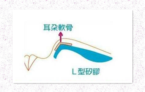 耳软骨垫鼻尖多久自然 耳软骨垫鼻尖多久定型