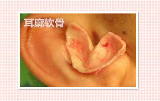 耳软骨垫鼻尖好取出么 耳软骨垫鼻子能取吗