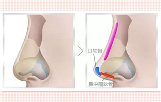 耳软骨隆鼻痛吗 耳软骨隆鼻拆线疼吗