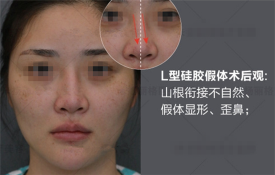 硅胶隆鼻失败案例 硅胶隆鼻失败图片