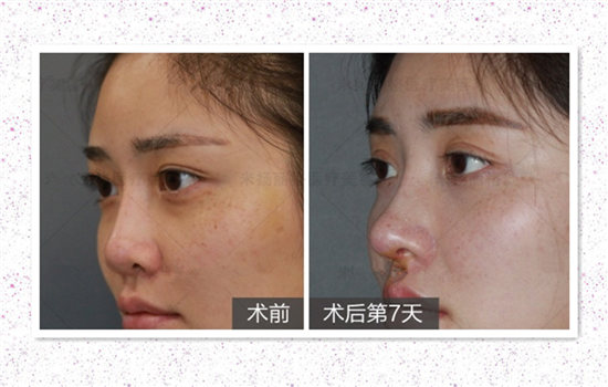硅胶隆鼻失败案例 硅胶隆鼻失败图片
