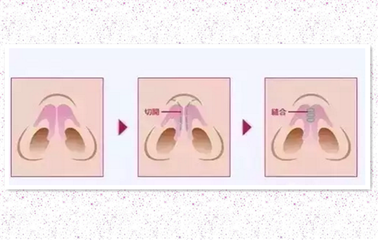 鼻翼缩小有几种方法 缩鼻翼怎么缩
