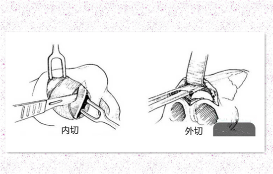 鼻翼内切是切鼻基底吗 鼻翼内切的切口在哪
