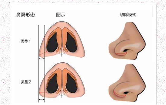 鼻翼缩小安全吗