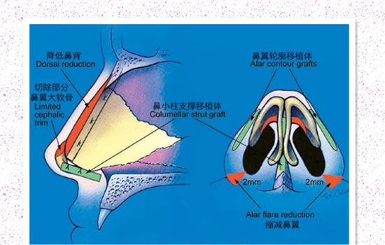鼻翼缩小安全吗