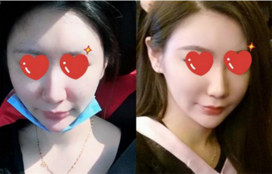 鼻翼内切效果图 鼻翼内切刚做完的图片
