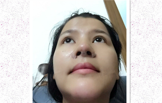 鼻头鼻翼缩小恢复日记 鼻头鼻翼缩小亲身经历