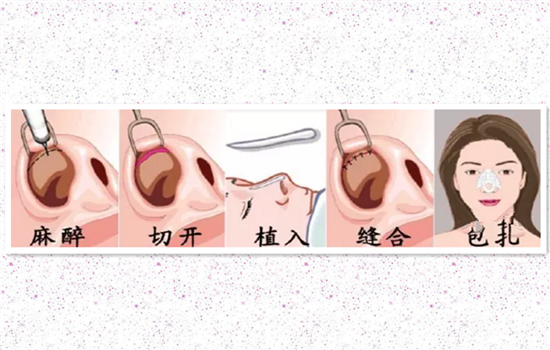 鼻小柱延长可以用耳软骨吗