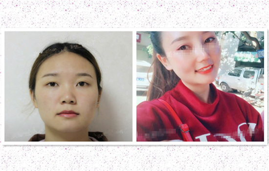 鼻小柱延长前后对比 鼻小柱延长效果图