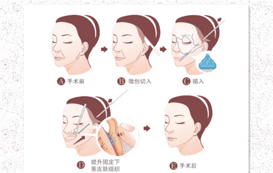 切眉手术后怎样消肿快 切眉怎么消肿