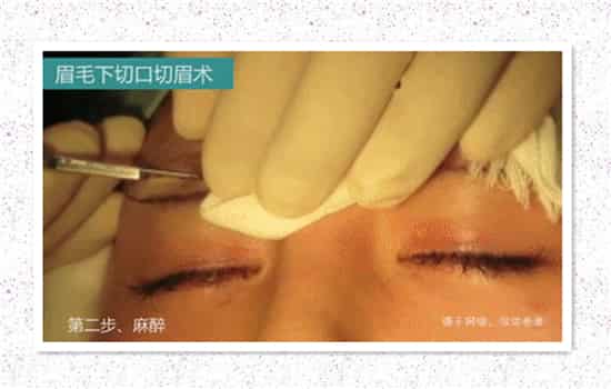 眉下切口提升图