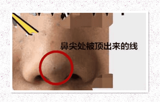 大v线可以做鼻子吗