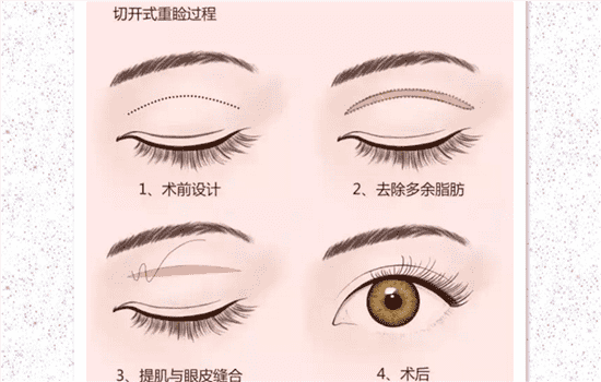 全切双眼皮安全吗