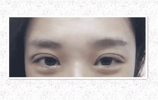 全切双眼皮能吃韭菜吗 割了双眼皮能吃韭菜吗