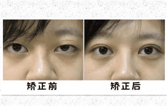 上睑下垂是什么 上睑下垂名词解释
