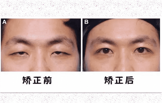 上睑下垂是什么 上睑下垂名词解释