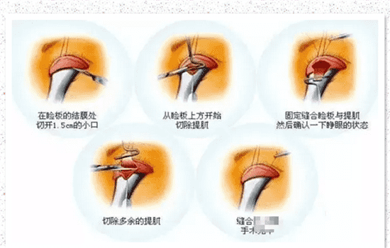 眼睑下垂手术适宜年龄