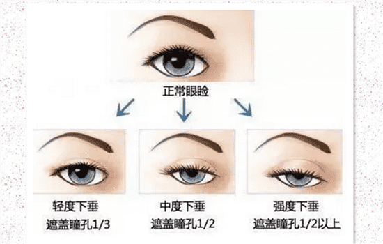 眼睑下垂会影响视力吗 上睑下垂会影响视力吗