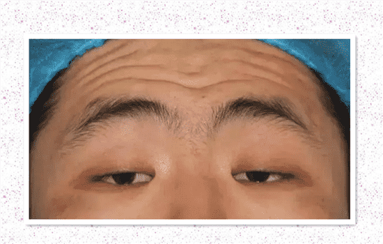 眼睑下垂会影响视力吗 上睑下垂会影响视力吗