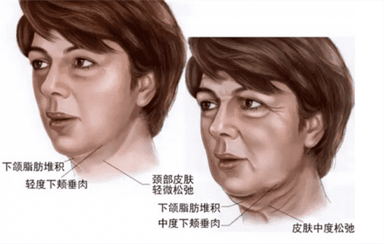 小v线和大v线哪个好看