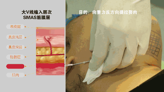 小v线提升操作图