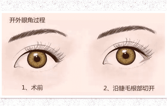 开外眼角怎么避免回缩