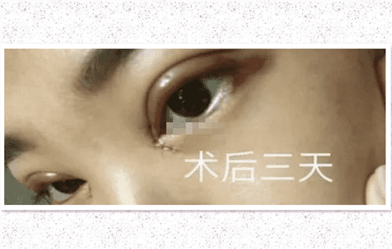 开内眼角一个月恢复图