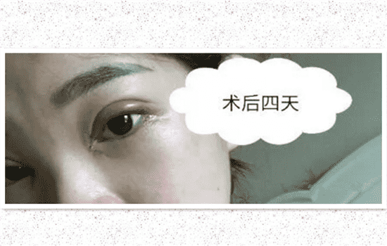 开内眼角一个月恢复图