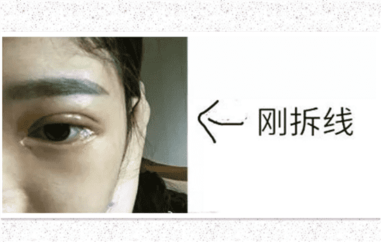 开内眼角一个月恢复图