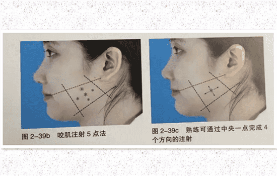 瘦脸针下垂还能恢复吗