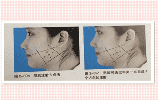 瘦脸针的打法 瘦脸针怎么打