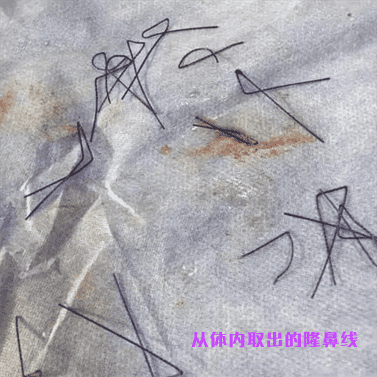 线雕隆鼻需要几根线 线雕隆鼻放几根线