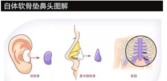 鼻子整形有几种方法