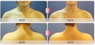 打肉毒素的作用