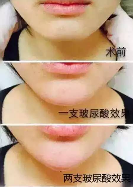 玻尿酸注射后注意事项 玻尿酸注射下巴后注意事项