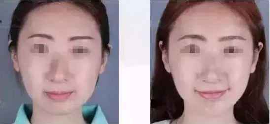 玻尿酸注射后注意事项 玻尿酸注射下巴后注意事项