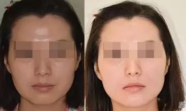 美白针有副作用吗 美白针效果